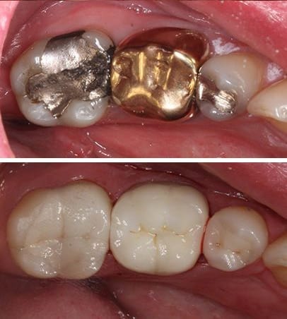 tooth color fillings