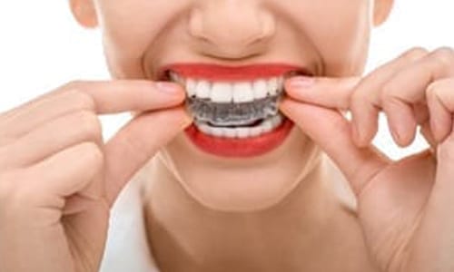 Benefit from Invisalign in Marietta