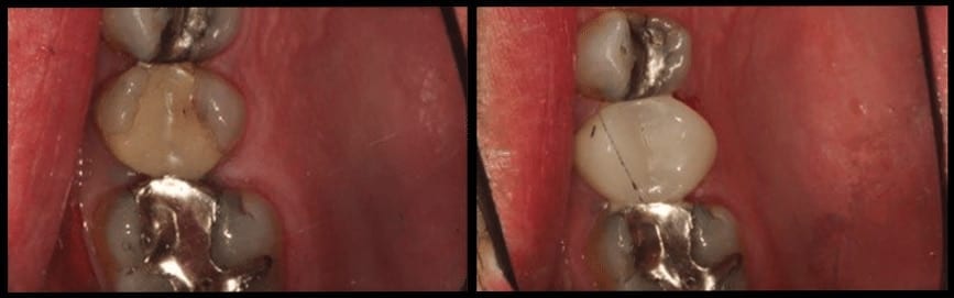 CEREC Crown Before & After