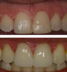 Jason's before and after porcelain veneers