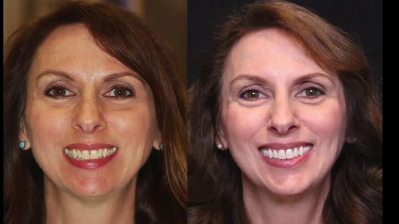 remedy overcrowded teeth with Invisalign