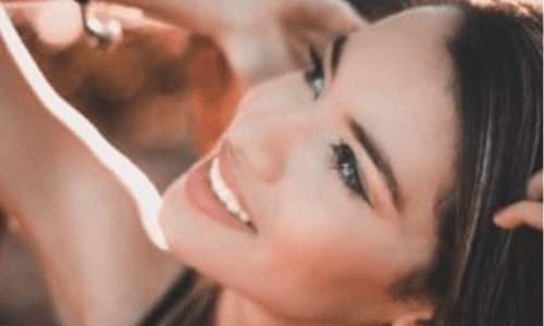 no-prep veneers for your smile