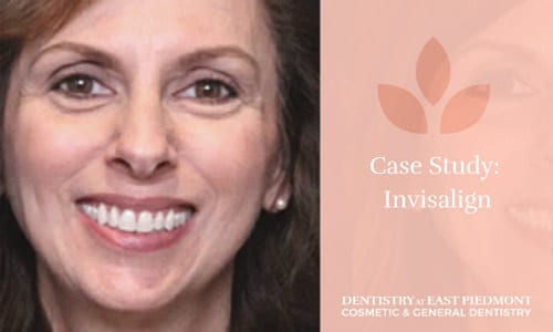 Annette's Invisalign Case Study