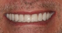 smile makeover example