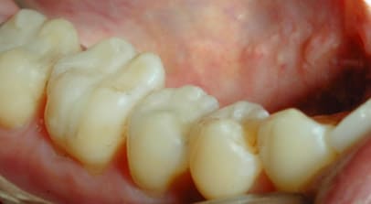 composite filling after