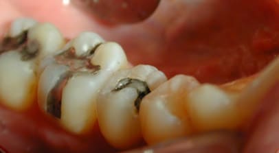 Composite Filling Before
