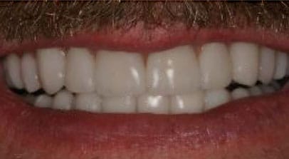 after full mouth reconstruction