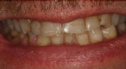 before full mouth reconstruction