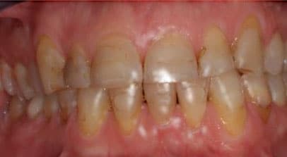 Loren before full mouth reconstruction