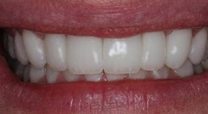after porcelain veneers
