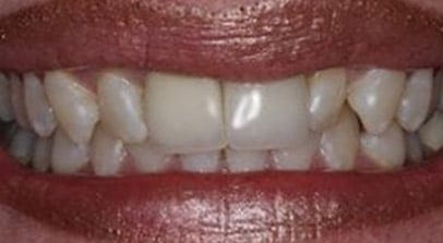 before porcelain veneers
