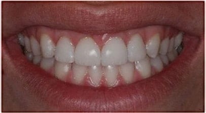 after veneer anterior