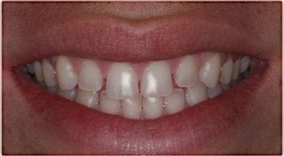 before veneer anterior