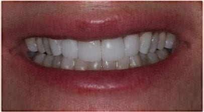 after veneer anterior