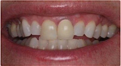 before veneer anteriors