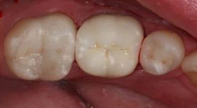 tooth color fillings after