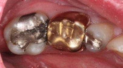 tooth color fillings before