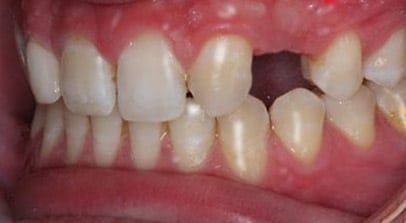 implant before