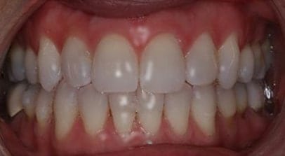 teeth whitening after Invisalign