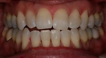 teeth whitening before Invisalign