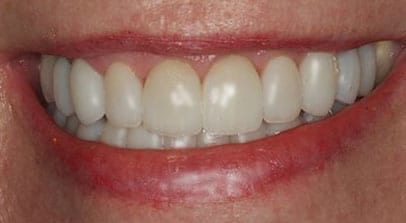 after full mouth reconstruction