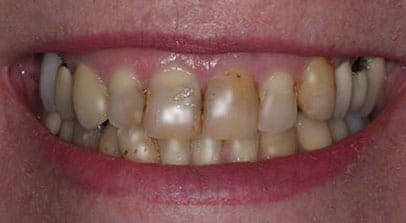 before full mouth reconstruction