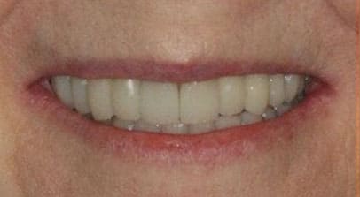 after full mouth reconstruction