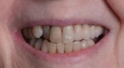 before full mouth reconstruction