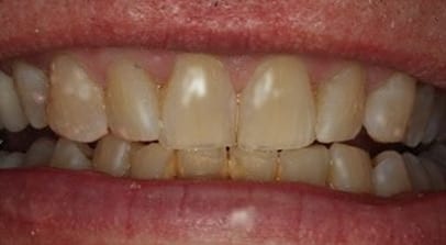 whitening before