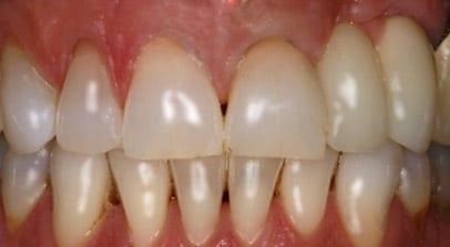 after implants