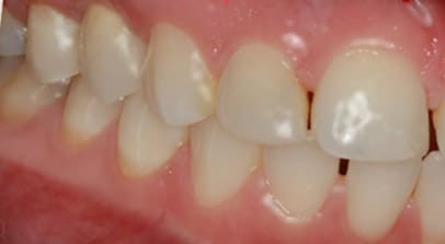 after implant