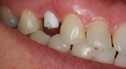 before implant