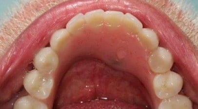 after implant denture hybrid