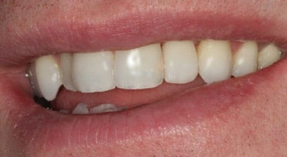 after single implant