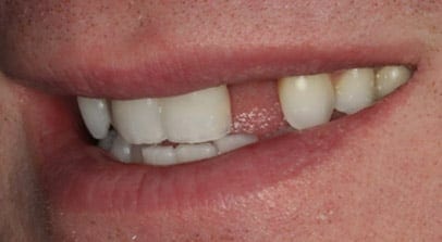 before single implant