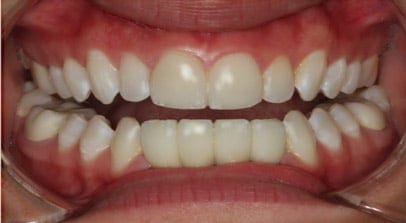 after lower implant bridge