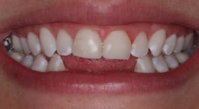 before lower implant bridge