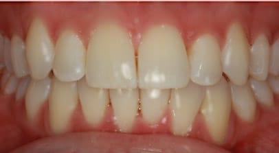 Kara after Invisalign