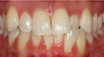 Kara before invisalign