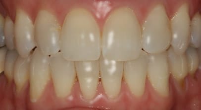 Rebecca after Invisalign