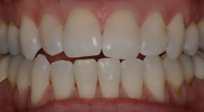 Rebecca before Invisalign