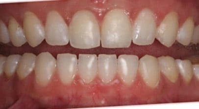 Tamara after Invisalign