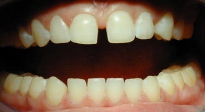Tamara before Invisalign