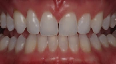 Wes after Invisalign