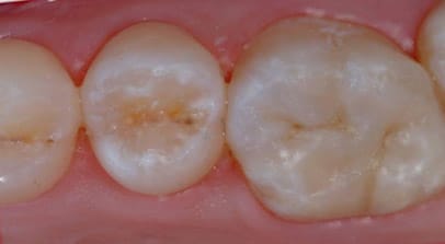 onlay filling posterior after