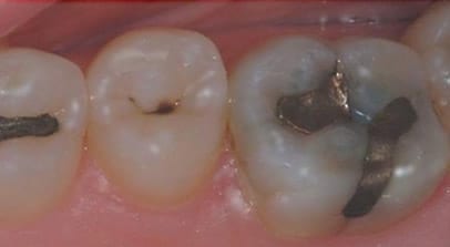 onlay filling posterior before