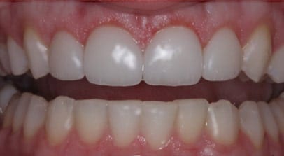 after crown veneer