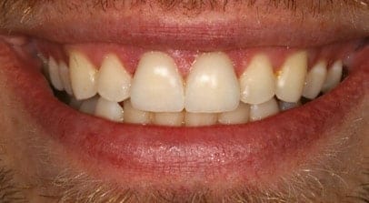 Jason after veneer crown