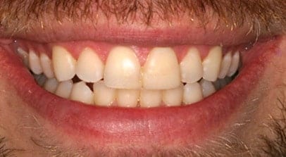 Jason before veneer crown