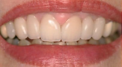 after lengthen veneers